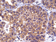 Photo 2 is on the left and a G1P3 Overexpression in Early Stage Breast Cancer.